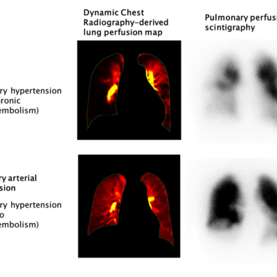 CTEPH diagnosis images produced using Dynamic Digital Radiography